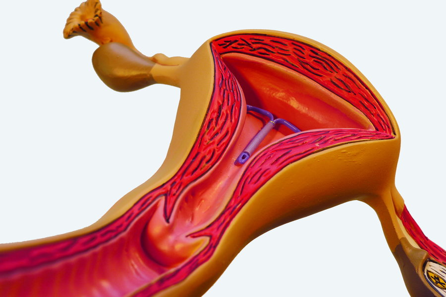 Aufgeschnittenes Gebärmuttermodel mit intrauterinen Verhütungssystem