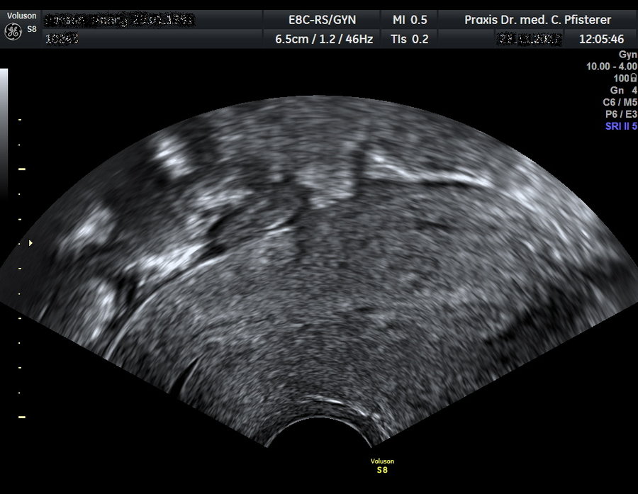 Gynäkologische Ultraschall